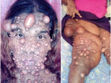 Lady covered with thousands of tumours after giving birth  %Post Title